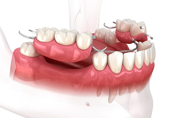 3D render of partial dentures