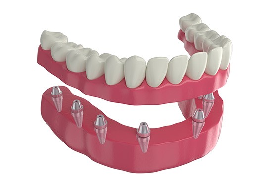 Render of implant dentures